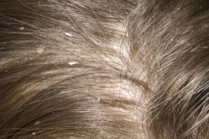 girl with dandruff