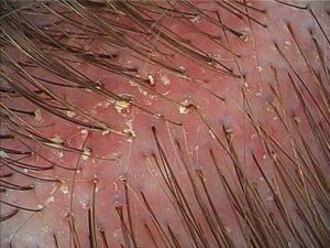 red sore scalp