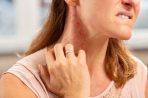lady with a rash on neck